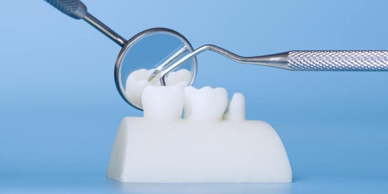 dental bridges clinton