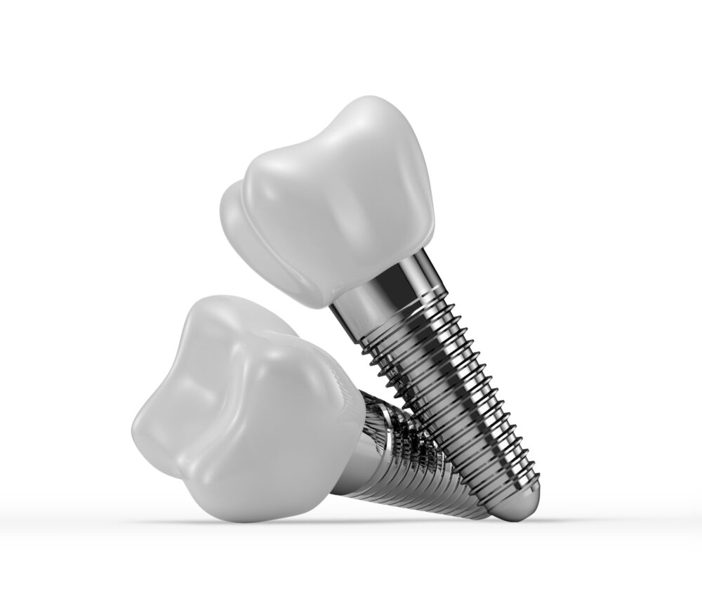 dental implants clinton